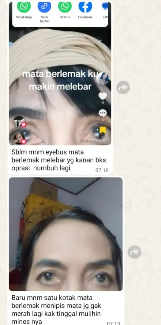 LEMAK-MATA-DAN-MINUS.webp